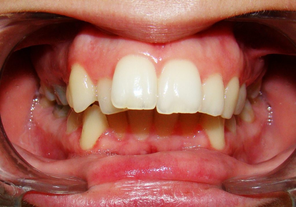 Συνωστισμός άνω και κάτω γνάθου & Πρόταξη άνω τομέων (πεταχτά δόντια)